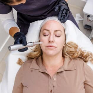 Microneedling Package of 4 Treatments