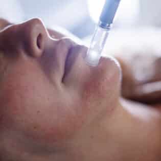 Microneedling + Exosomes Package of 4 Treatments